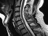 cspine
