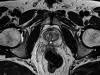 prostate
