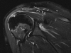 shoulder3