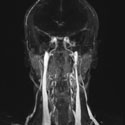 Vancouver MRI Scan Jugular Veins