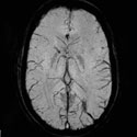 Vancouver MRI Brain Scan