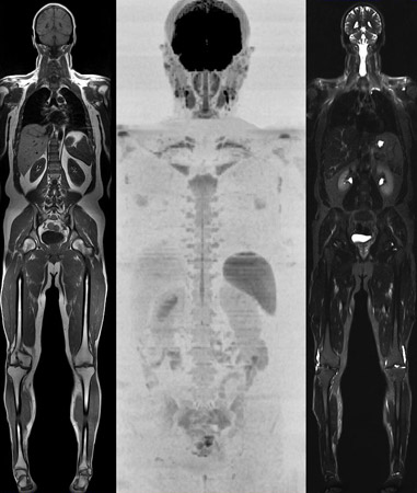 AIM's Whole Body Diffusion MRI