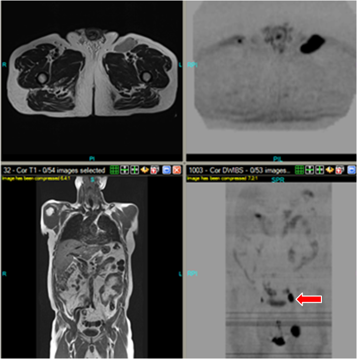 Lymphoma, well seen with DWIBS at AIM Medical Imaging