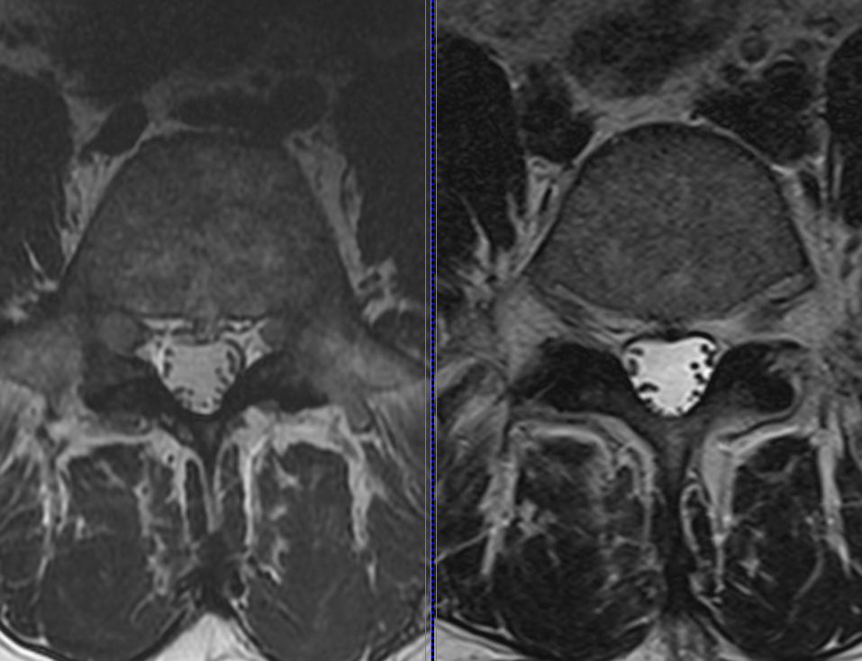 3T vs. 1.5T in MRI of Lumbar Spine