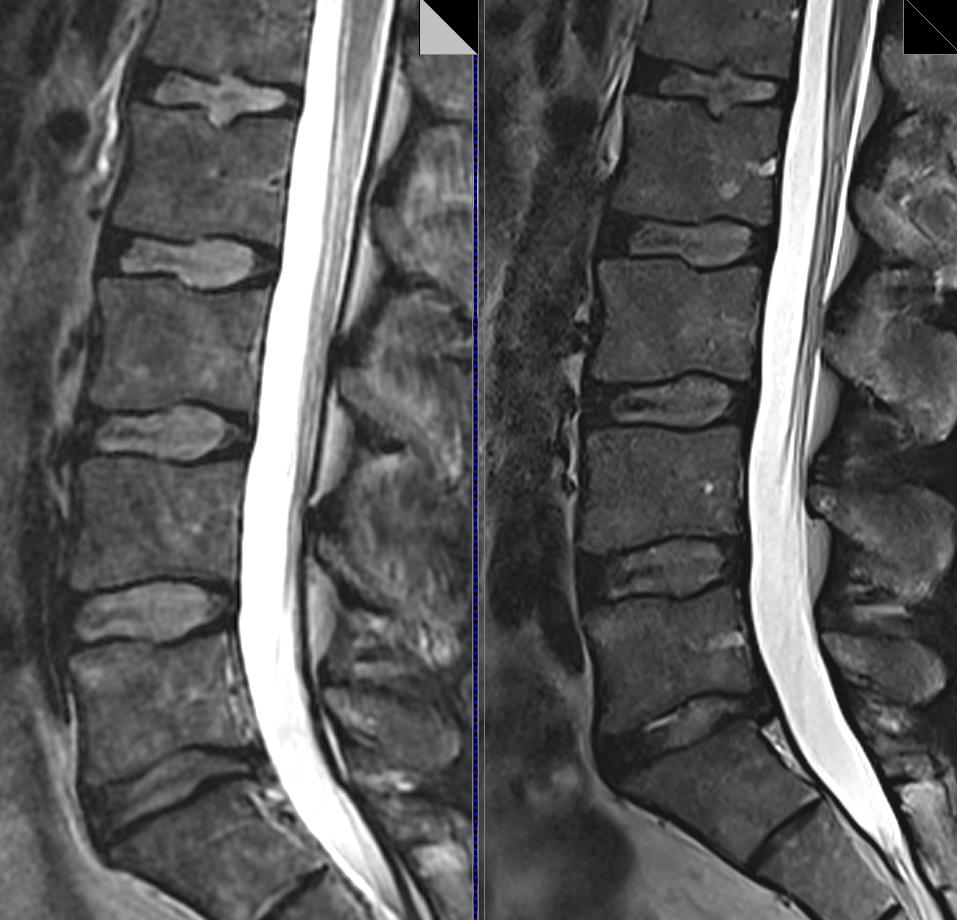 3T vs. 1.5T MRI - Lumbar Spine