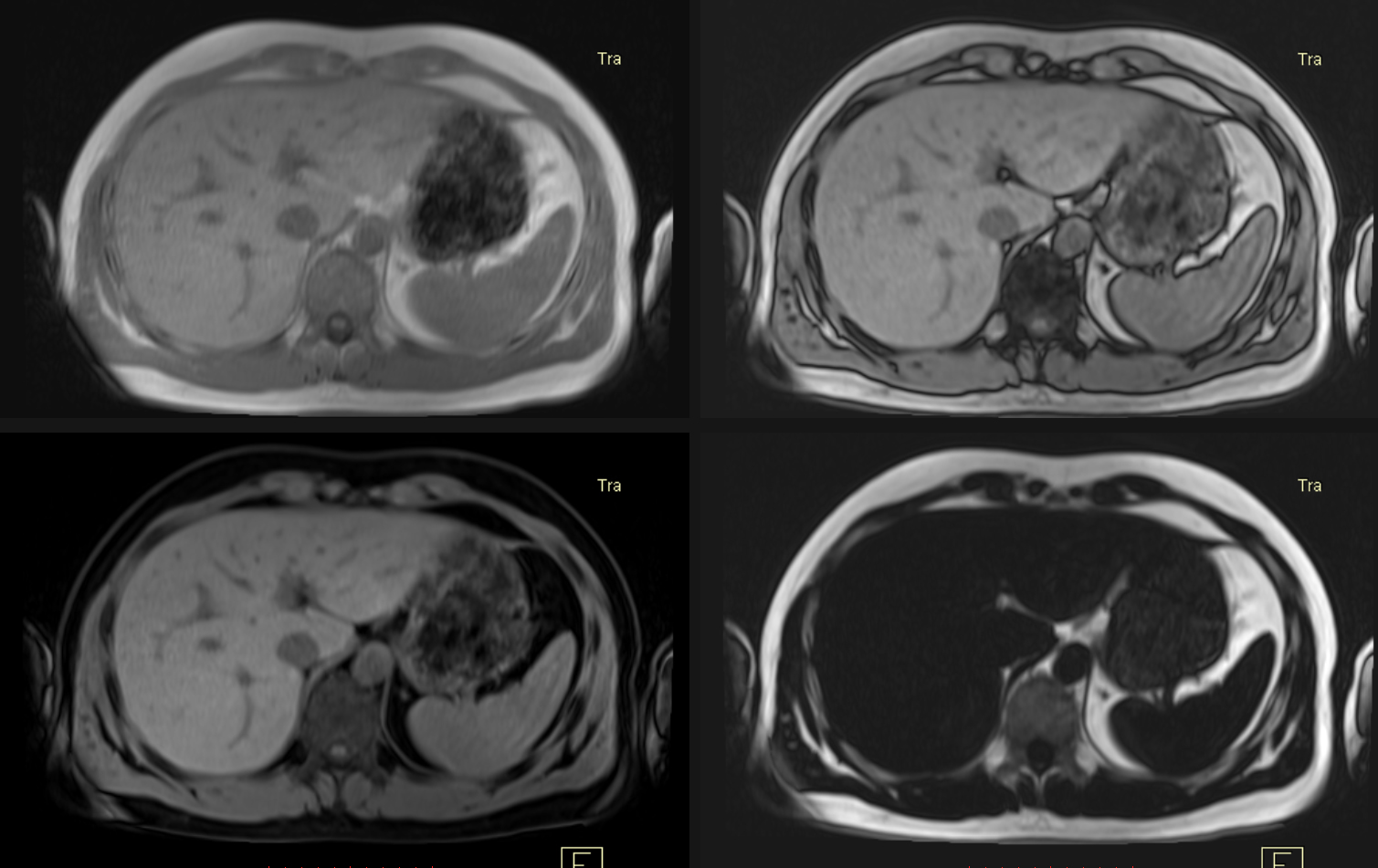 New Research finds Superior for Liver Cancer Diagnosis – Aim Medical Imaging