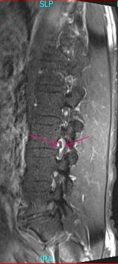 Nerve Sheath Tumour in Spine- sagittal view